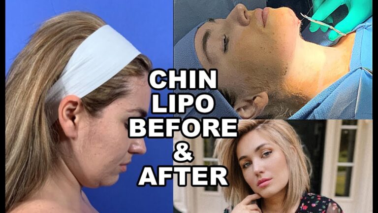 The Best Time to Get NYC Chin Liposuction: How to Choose the Right Season and Schedule for Your Surgery